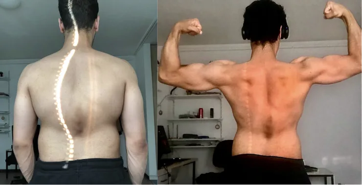 Member posture change, back view of spine before and after